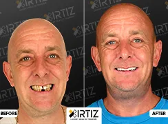 Turkey Teeth Pictures Smile Makeover