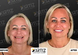 Turkey Teeth Pictures All-On-6 Implant