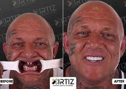 Turkey Teeth Pictures Implant Zirconium