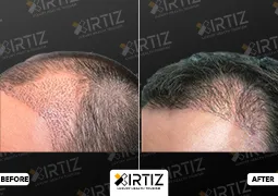 Hair Transplant in Turkey Picture