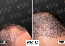 Hair Transplant in Turkey Picture