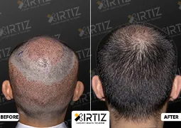 Hair Transplant in Turkey Picture