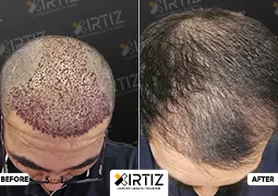 Hair Transplant in Turkey Picture