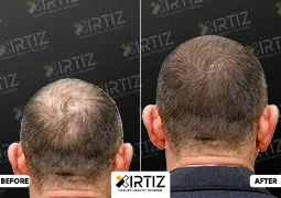 Hair Transplant in Turkey Picture