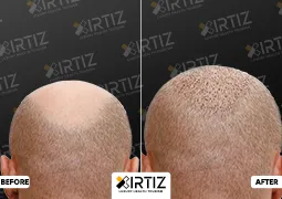 Hair Transplant in Turkey Picture