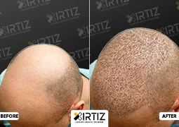 Hair Transplant in Turkey Picture