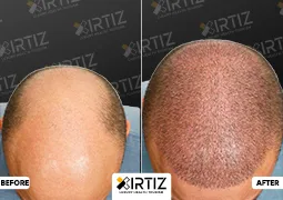 Hair Transplant in Turkey Picture