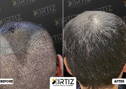 Hair Transplant in Turkey Picture