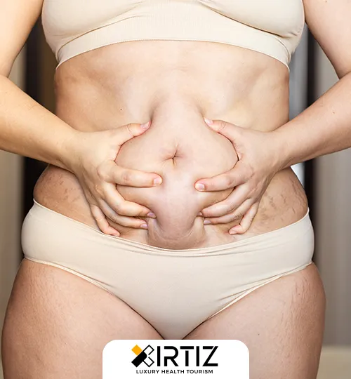 Tummy Tuck Aesthetics Treatment and Cost in Turkey