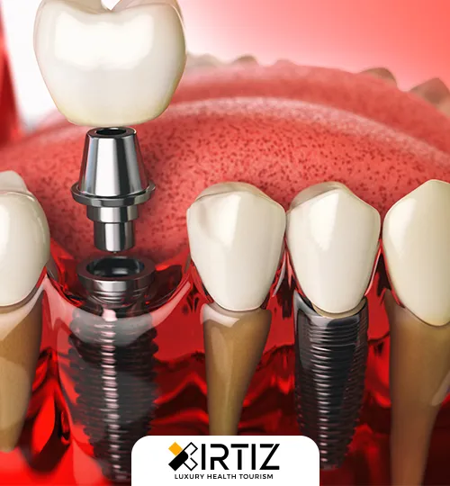 Dental implant treatment and cost in Turkey