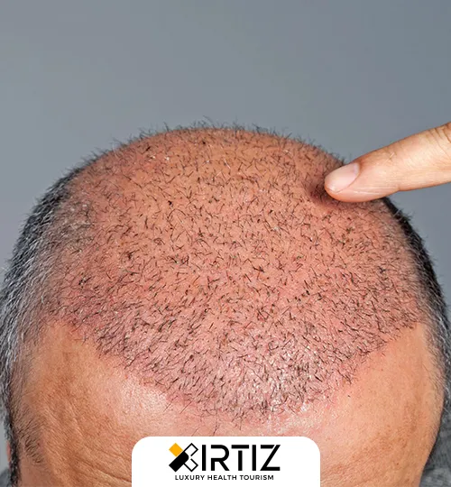 Hair Transplantation and Treatment With Sapphire Transplantation Technique in Turkey