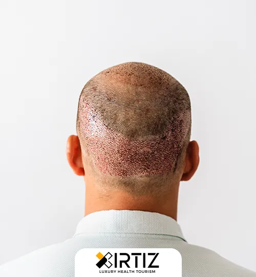 Hair Transplantation and Treatment With Direct Hair Transplantation Technique in Turkey