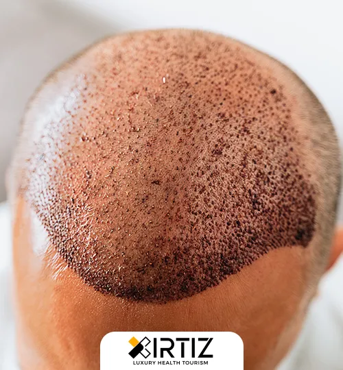 Hair Transplant Treatment and Cost in Turkey