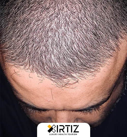 Hair Transplantation and Treatment With Manuel Transplantation Technique in Turkey