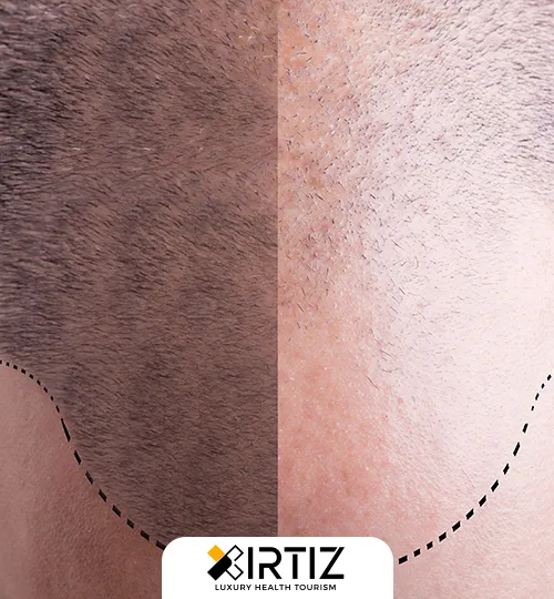 Hair Transplantation and Treatment With Needle Free Anesthesia Technique in Turkey